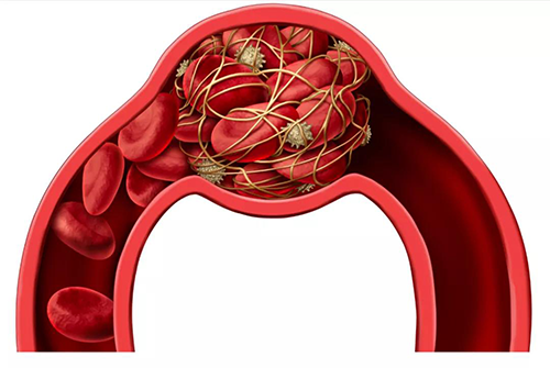 脑中风是一种以脑部缺血及出血性危险症状为重要临床阐发的疾病
