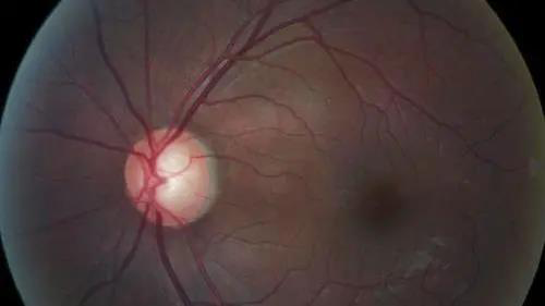 青光眼的克星来袭，助力患者远离视力的“窃贼”