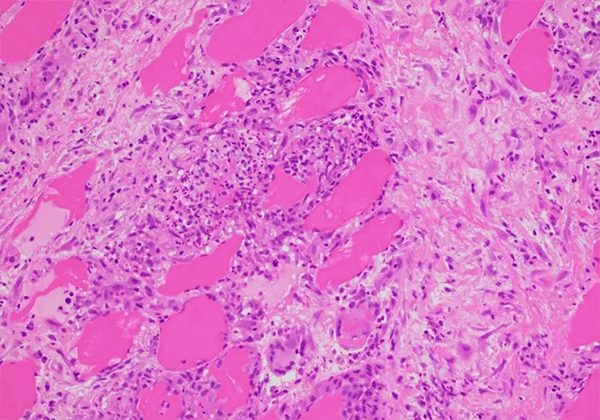 【和记H88助力】医治结节病的KBMAB-16获FDA核准临床